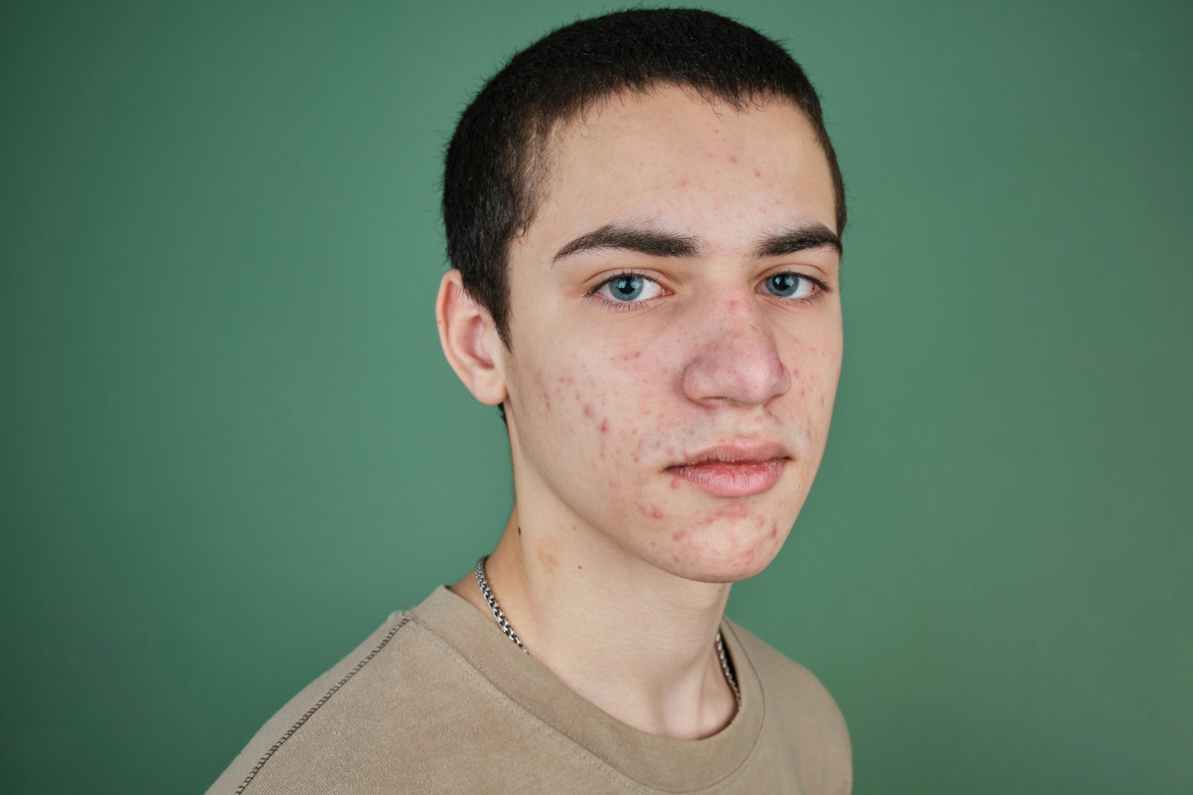 The Skin Barrier and Acne: Why “Fighting Breakouts” Is Often Making Them Worse