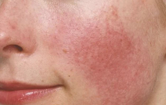 Rosacea, Eczema, and the Skin Barrier: Why Sensitive Skin Needs Less, Not More