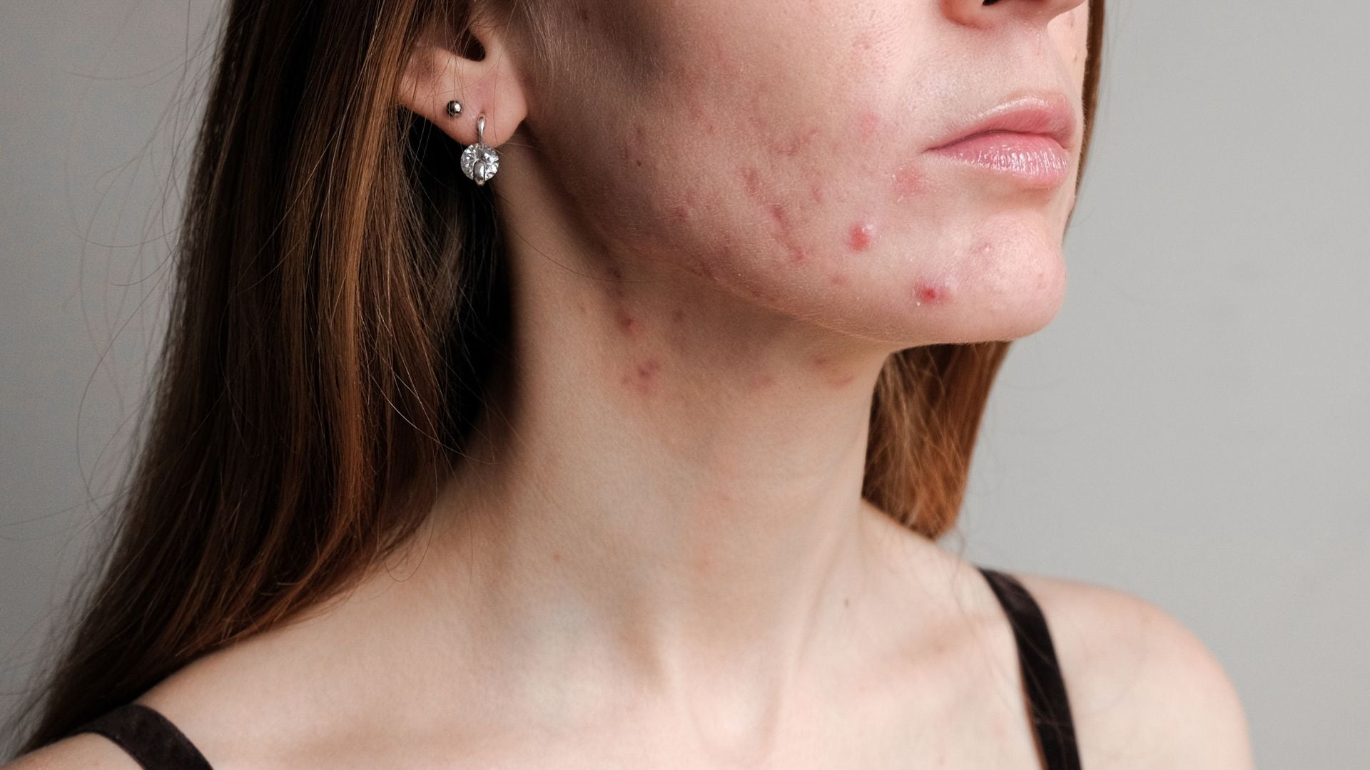 Woman with acne on her face and neck for treatment with products with Microsilver BG™